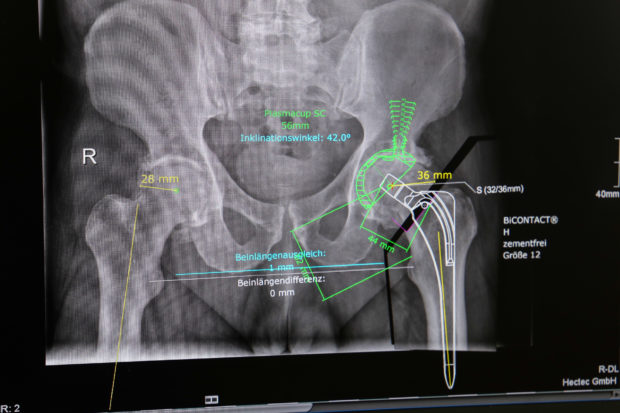 Digitale MRT-, CT- oder Röntgenaufnahmen gepaart mit neuer Prothesenplanungssoftware erleichtern das Arbeiten der Chirurgen. So könnte ein Bild bei einer Hüft-OP aussehen, anhand derer sich der Operateur orientiert. Foto: Anja Kierblewski